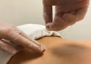 Close-up of a practitioner inserting a thin needle into a person’s neck during a dry needling treatment while the person lies face down.